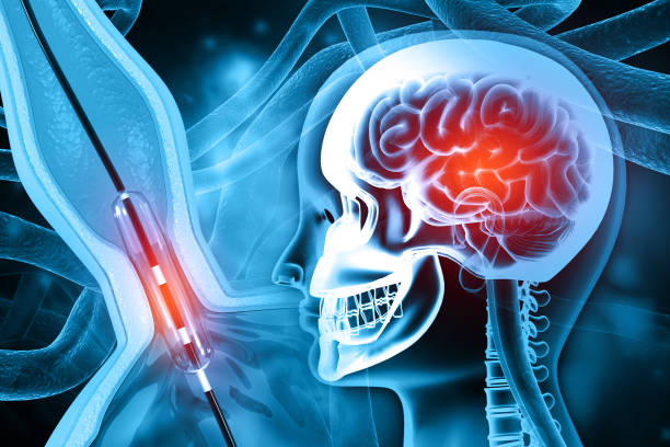 Best Neuro Surgeon Zirakpur